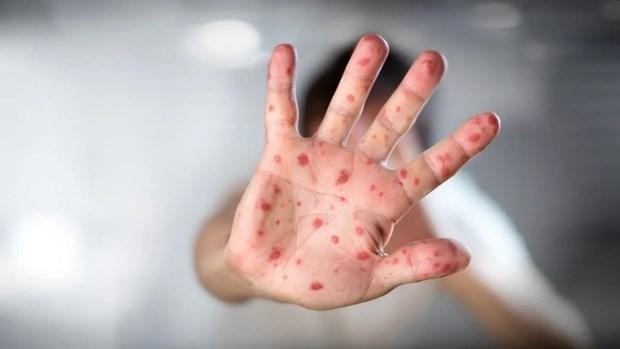 Bệnh đậu mùa có gây nguy hiểm cho con người không?
