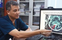 Tiến sĩ, bác sĩ Nguyễn Trung Nguyên cho biết tổn thương mắt myelin hình tai thỏ đảo ngược đặc trưng ở tủy sống do sử dụng N20. Ảnh: DÂN VIỆT