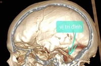 Các bác sĩ chụp CT cho bệnh nhân phát hiện một chiếc đinh đâm xuyên sọ nằm sâu trong não bệnh nhân.