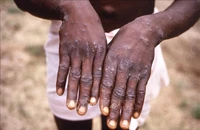 Bệnh nhân mắc đậu mùa khỉ tại Cộng hòa dân chủ Congo. (Ảnh: AFP/TTXVN)