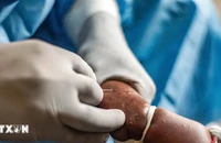Nhân viên y tế điều trị cho bệnh nhân mắc đậu mùa khỉ tại Goma, Cộng hòa dân chủ Congo, ngày 15/8/2024. (Ảnh: THX/TTXVN)