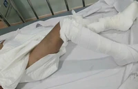 Hình ảnh cháu K. đang điều trị bỏng tại bệnh viện.
