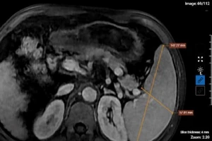 Kết quả chụp MRI của bệnh nhân nghiện rượu cho thấy hình ảnh xơ gan lách to, dịch bao quanh gan. (Ảnh: BVCC)