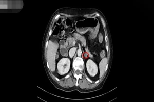 Trên phim CT scan thấy tuyến thượng thận trái (vòng tròn đỏ) của bà V. teo nhỏ, nhiều sang thương. 