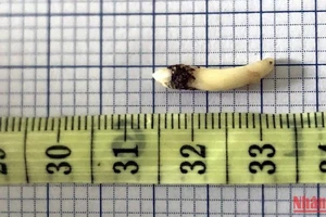 Chiếc răng dài khoảng 2cm được lấy ra khỏi hốc mũi bệnh nhân.