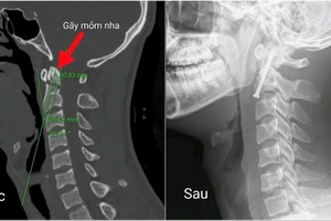 Phẫu thuật nội soi vít trực tiếp mỏm nha là một tiến bộ trong phẫu thuật cột sống cổ.