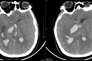 Kết quả chụp lại phim MSCT mạch não chảy máu não đồi thị - não thất do vỡ khối AVM của bệnh nhân 15 tuổi.