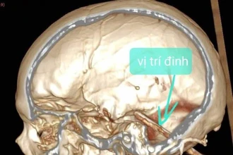 Các bác sĩ chụp CT cho bệnh nhân phát hiện một chiếc đinh đâm xuyên sọ nằm sâu trong não bệnh nhân.