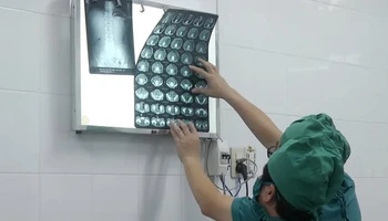 Các bác sĩ theo dõi viên đạn trong người anh Giáp qua phim chụp X-quang.