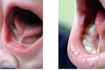 Trẻ mắc dị tật dính lưỡi.
