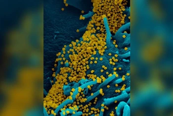 Hình ảnh hiển vi điện tử quét virus SARS-CoV-2 thu được từ một phụ nữ mắc Covid-19 phát tán virus liên tục trong 70 ngày. Ảnh: NIAID-RML.