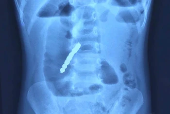 Hình ảnh chụp X-quang phát hiện bảy viên bi nam châm gây thủng ruột bệnh nhi.