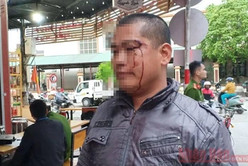 Anh Triệu La Luyện bị đánh gây thương tích, chảy máu vùng mặt.