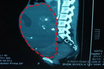 Hình ảnh khối u trước khi được bóc tách qua soi chụp. (Ảnh: Bệnh viện Xuyên Á)