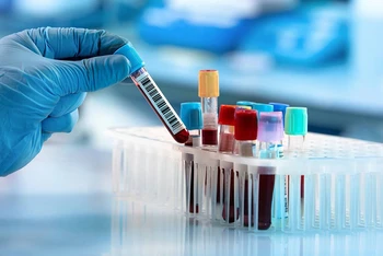 Phương pháp xét nghiệm máu Galleri được cho là có thể giúp phát hiện sớm hơn 50 loại ung thư. (Ảnh minh họa: GHP News)