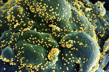 Một tế bào (xanh dương/xanh lục) bị nhiễm nặng các hạt virus SARS-CoV-2 (màu vàng), được phân lập từ mẫu của bệnh nhân Covid-19. (Ảnh: AFP/TTXVN)