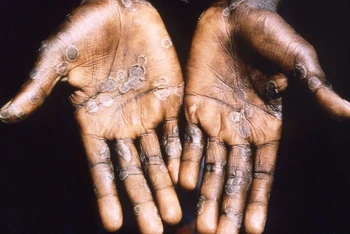 Lòng bàn tay của 1 bệnh nhân mắc bệnh đậu mùa khỉ ở Lodja, Cộng hòa dân chủ Congo. (Ảnh: CDC/Reuters)