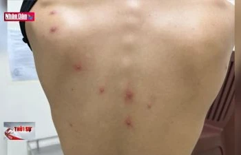 Việt Nam có ca tử vong đầu tiên liên quan bệnh đậu mùa khỉ