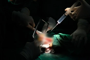 Các bác sĩ phẫu thuật xử lý chân bị hoại tử. 