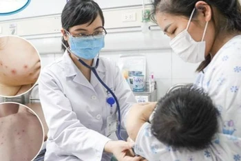 Bác sĩ khám cho bệnh nhi mắc thủy đậu. 