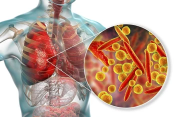Viêm phổi do mycoplasma là một bệnh nhiễm trùng ở phổi khá phổ biến.