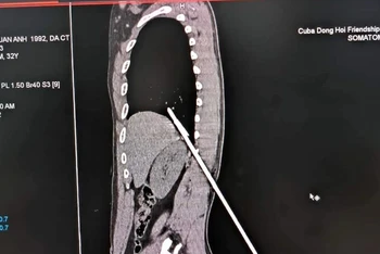 Mũi tên thép đâm vào người gây nhiều thương tổn cho bệnh nhân. (Ảnh: ĐC)