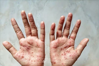 Các ban đỏ nổi trên tay 1 bệnh nhân mắc bệnh đậu mùa khỉ. (Ảnh: Shutterstock/TTXVN)