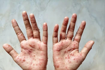 Các ban đỏ nổi trên tay 1 bệnh nhân mắc đậu mùa khỉ. (Ảnh: Shutterstock/TTXVN)