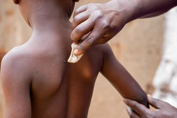 Một bệnh nhi hồi phục sau khi khỏi bệnh mpox, Bujumbura, Burundi, ngày 28/8/2024. (Ảnh: Reuters) 