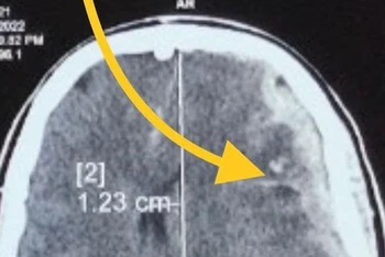 Hình ảnh cho thấy bệnh nhân bị tổn thương não.