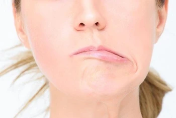 Méo miệng về một bên là triệu chứng điển hình của bệnh liệt dây thần kinh số 7. (Ảnh minh họa)