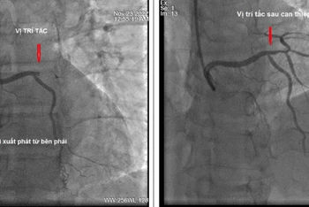 Hình ảnh chụp động mạch vành trước và sau khi can thiệp. (Ảnh: BVCC)