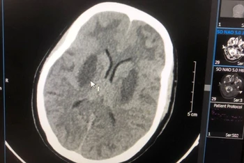 Hình ảnh tổn thương não của bệnh nhân Triệu Văn N.