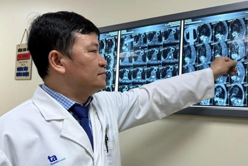 Bác sĩ Bảo Ngọc đang xem xét khối u của ông L. nằm trọn trong ống sống ngực. 