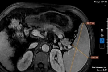 Kết quả chụp MRI của bệnh nhân nghiện rượu cho thấy hình ảnh xơ gan lách to, dịch bao quanh gan. (Ảnh: BVCC)