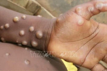 Bệnh đậu mùa khỉ có thể có các tổn thương trên da. (Ảnh: Getty Images/TTXVN)