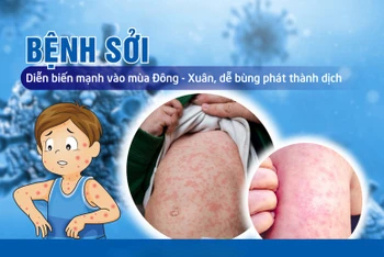 Thủ tướng Chính phủ chỉ đạo tăng cường công tác phòng, chống bệnh sởi