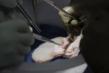 Các bác sĩ phẫu thuật tại NYU Langone Health chuẩn bị ghép thận lợn cho một người đàn ông chết não vào ngày 14/7. Ảnh: AP 