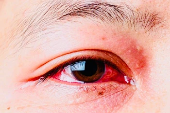 Bệnh đau mắt đỏ đang có nguy cơ bùng phát trên địa bàn thành phố Hải Phòng nếu không được phòng tránh tốt.