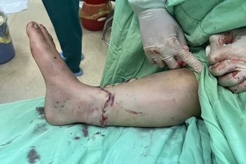 Ca phẫu thuật kéo dài 5 giờ nối thành công bàn chân bị đứt rời cho bệnh nhân P.T.P bị tai nạn giao thông.