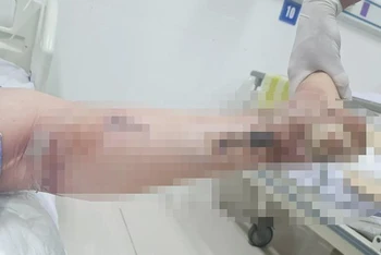Hoại tử chân ở người bệnh đái tháo đường