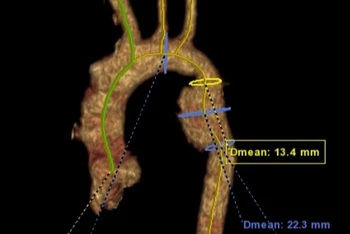 Hình ảnh dựng 3D tổn thương động mạch chủ.