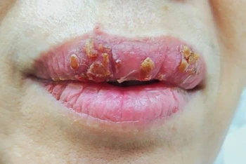 Nhiễm trùng môi vì làm đẹp cấp tốc