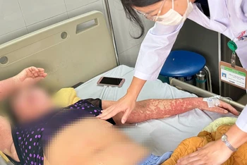 Biểu hiện dị ứng thuốc nặng của bệnh nhân.