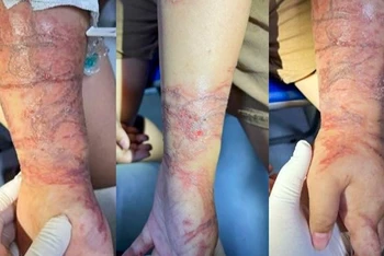 Tổn thương của bệnh nhi khi tiếp xúc với sứa biển.