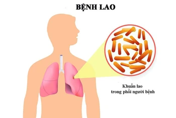 Thủ tướng Chính phủ chỉ đạo tăng cường công tác phòng, chống bệnh Lao