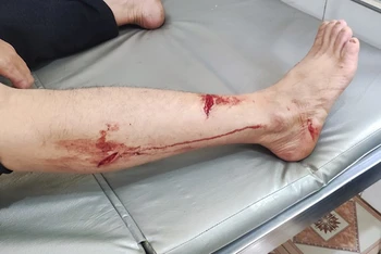 Ông Đinh Như Quý bị voọc cắn rách chân phải khâu 6 mũi.