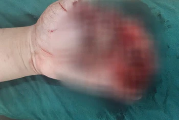 Bàn tay trái của cháu L.V.L. bị dập nát do điện thoại phát nổ.