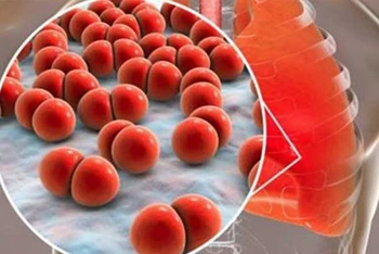 Cuba nghiên cứu phát triển vaccine chống lại phế cầu khuẩn