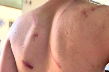 Các vết thương trên người cháu T.N.A.